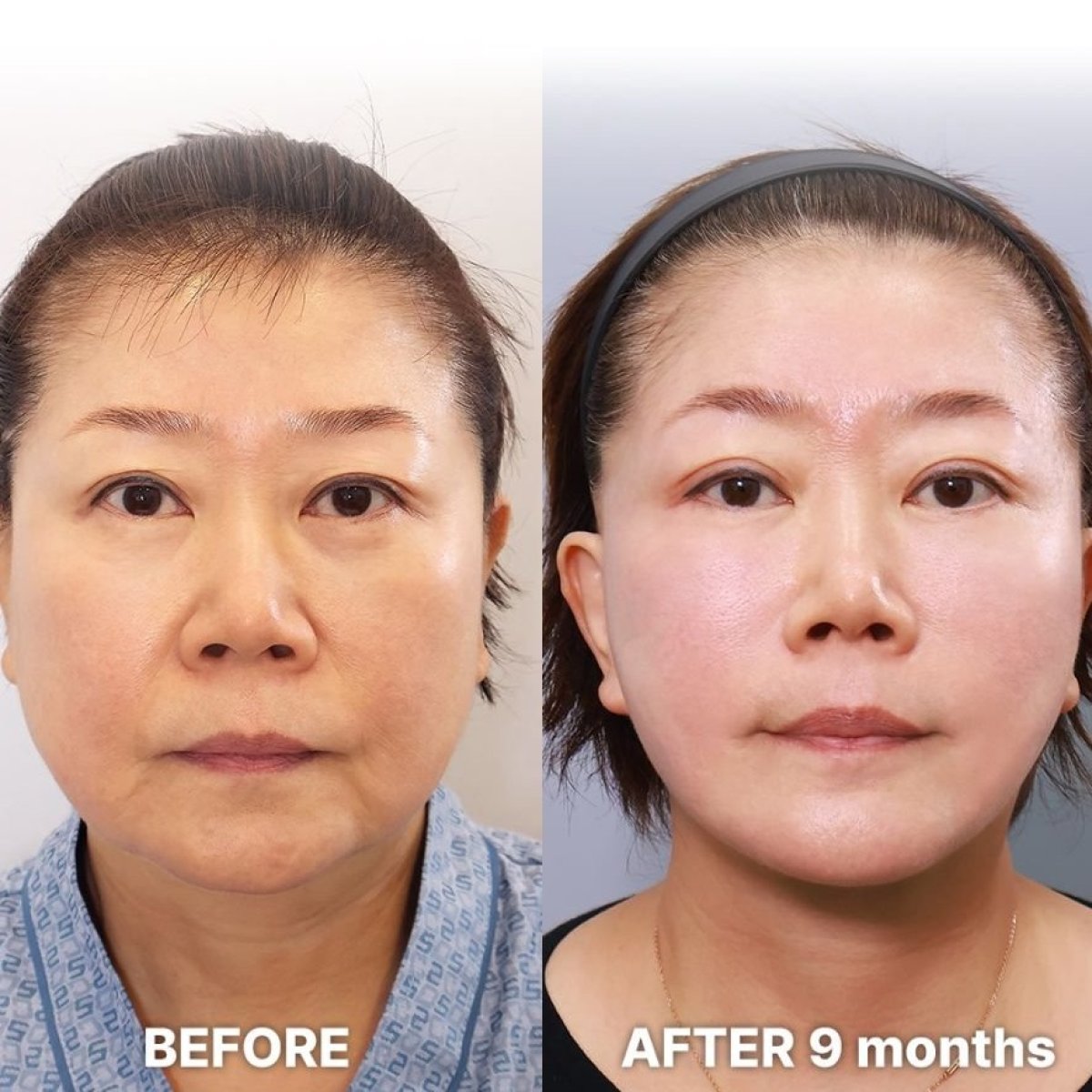 Before and after deep plane facelift results at Returning Plastic Surgery, 9 months post-op