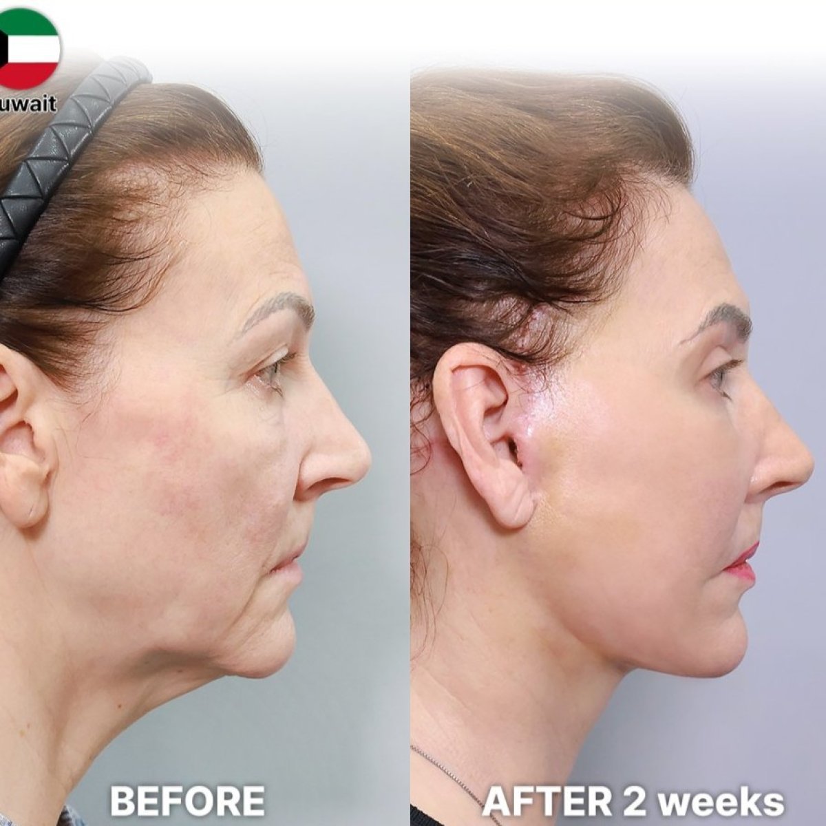 Before and after deep plane facelift results at Returning Plastic Surgery – facial rejuvenation