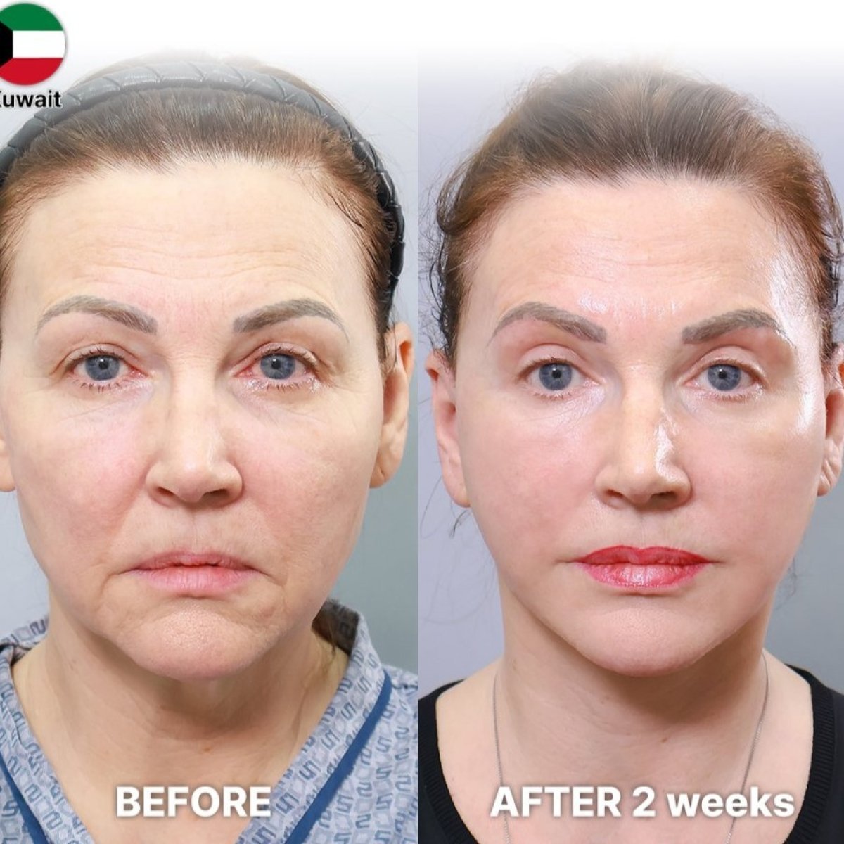 Before and after Deep Plane Facelift results at Returning Plastic Surgery, 2 weeks post-op