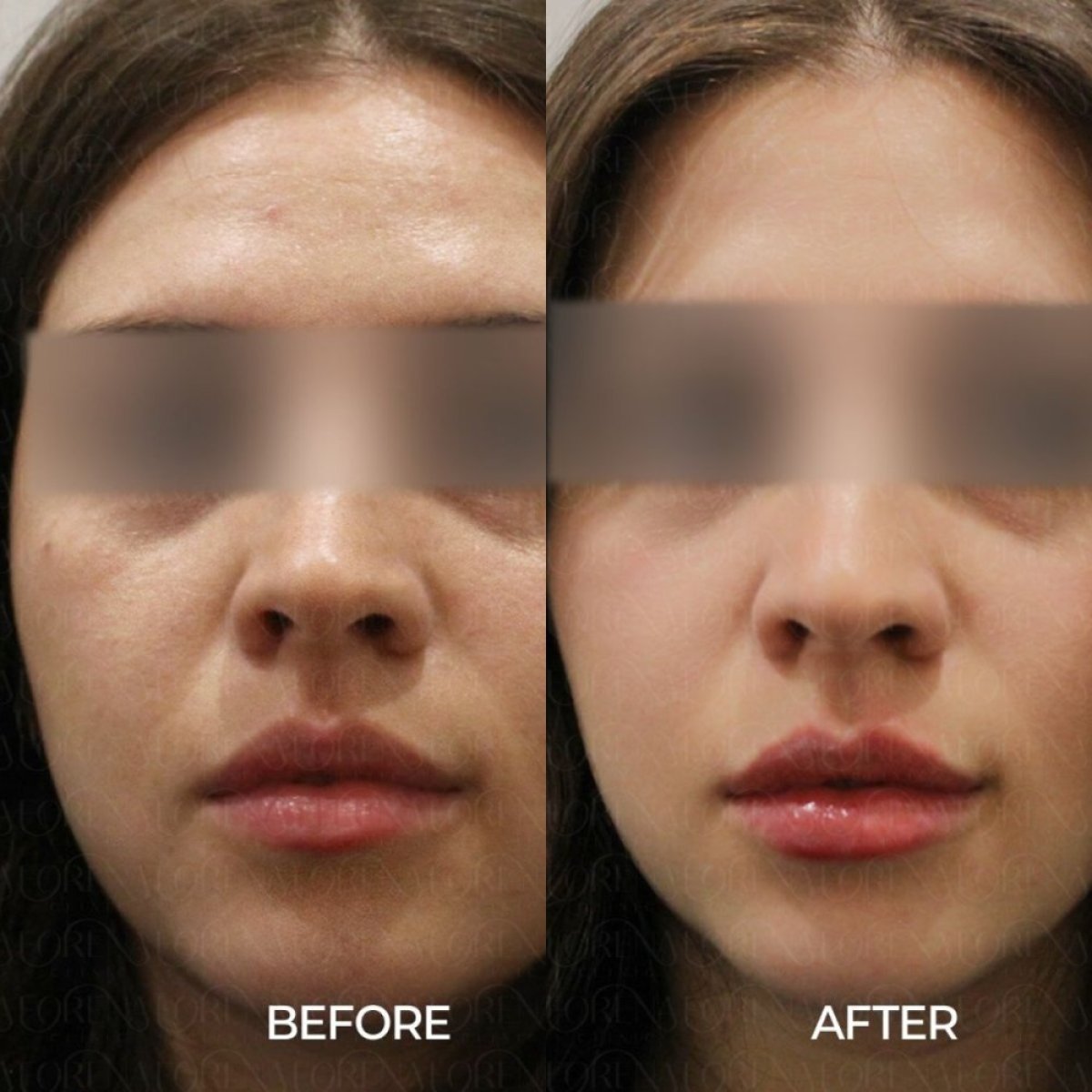 Before and after Botox for forehead at Forena Clinic, smoother skin and reduced wrinkles result