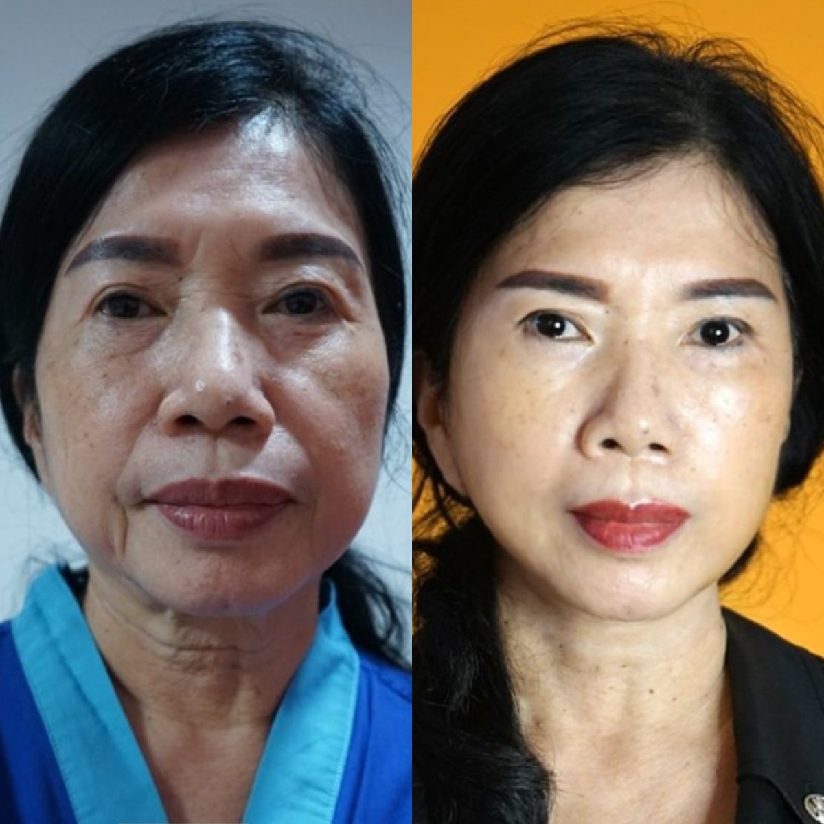 Facelift before and after results at Asia Cosmetic Hospital, visible facial rejuvenation outcome
