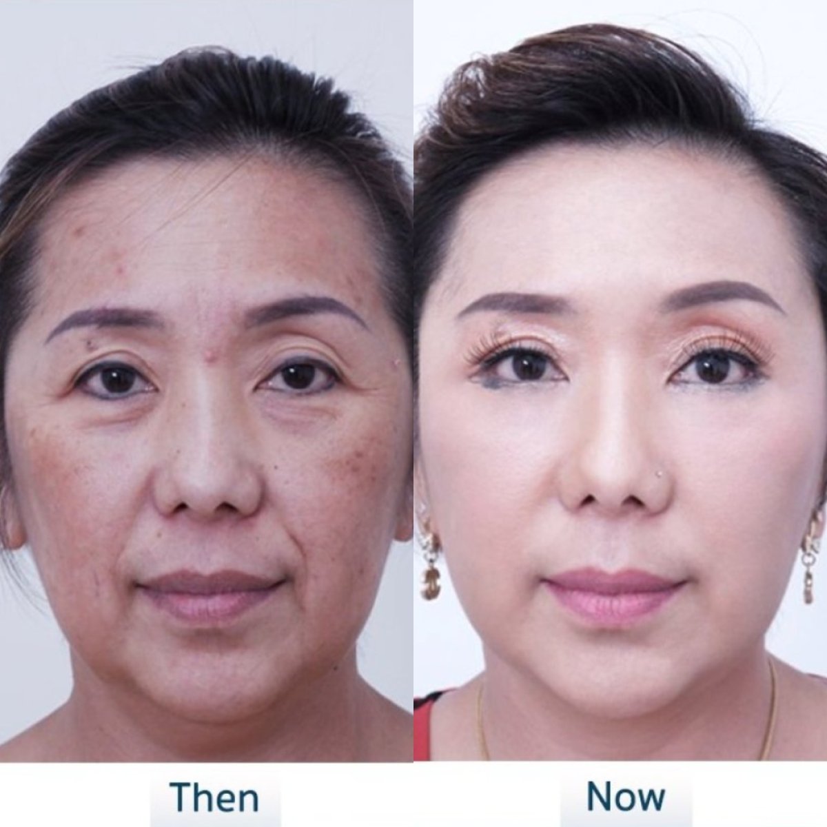 Facelift before and after results at Asia Cosmetic Hospital, visible facial rejuvenation effect