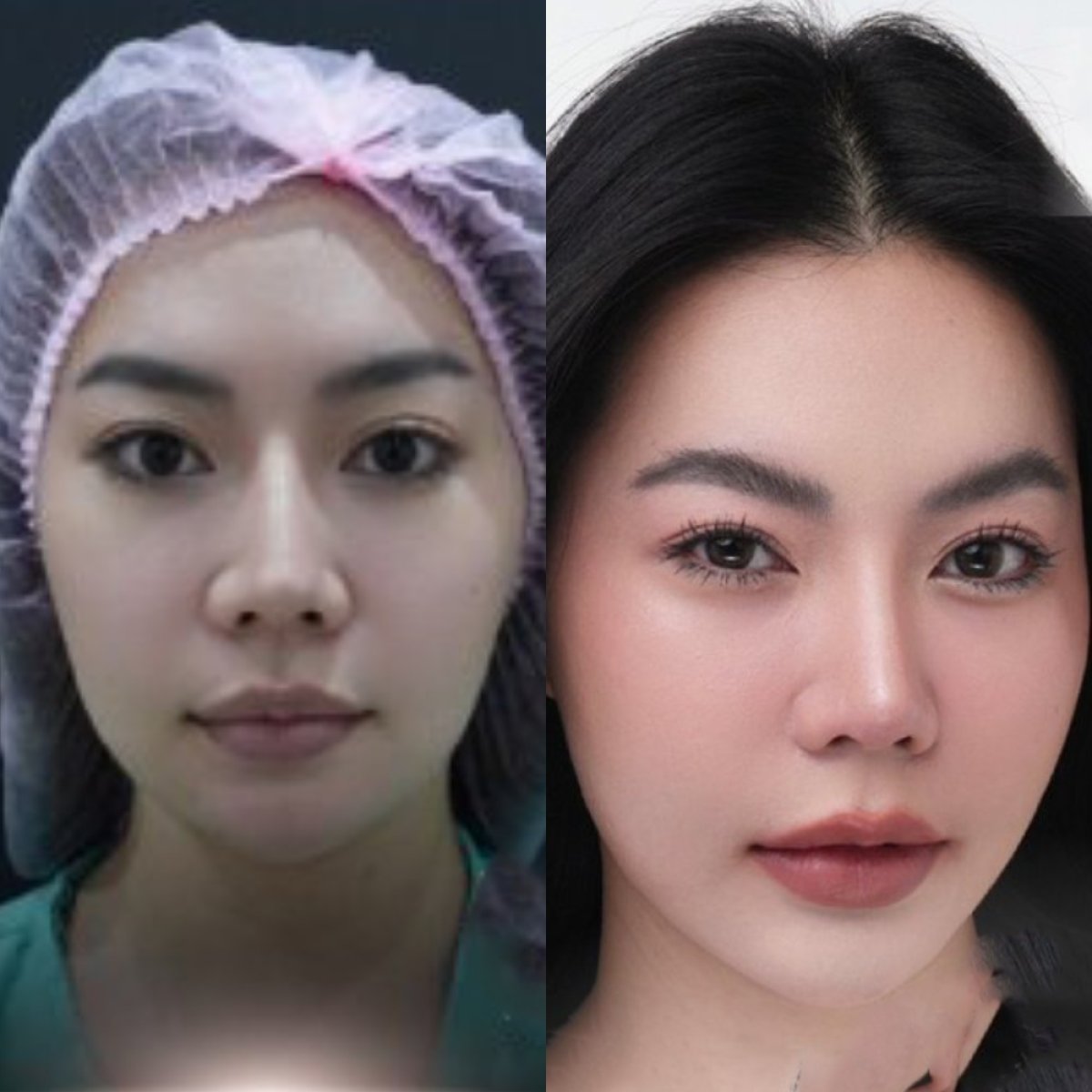 نتائج عملية تجميل الأنف قبل وبعد، إعادة تشكيل الأنف لتحسين تناسق الوجه
