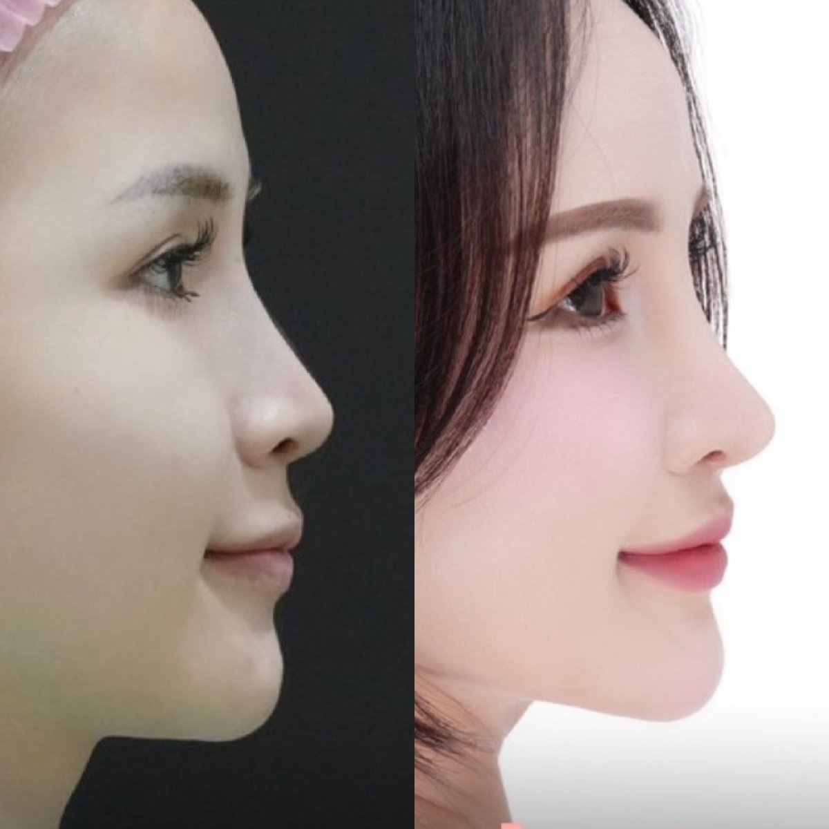 نتائج تجميل الأنف قبل وبعد، إعادة تشكيل الأنف وتحسين المظهر الطبيعي