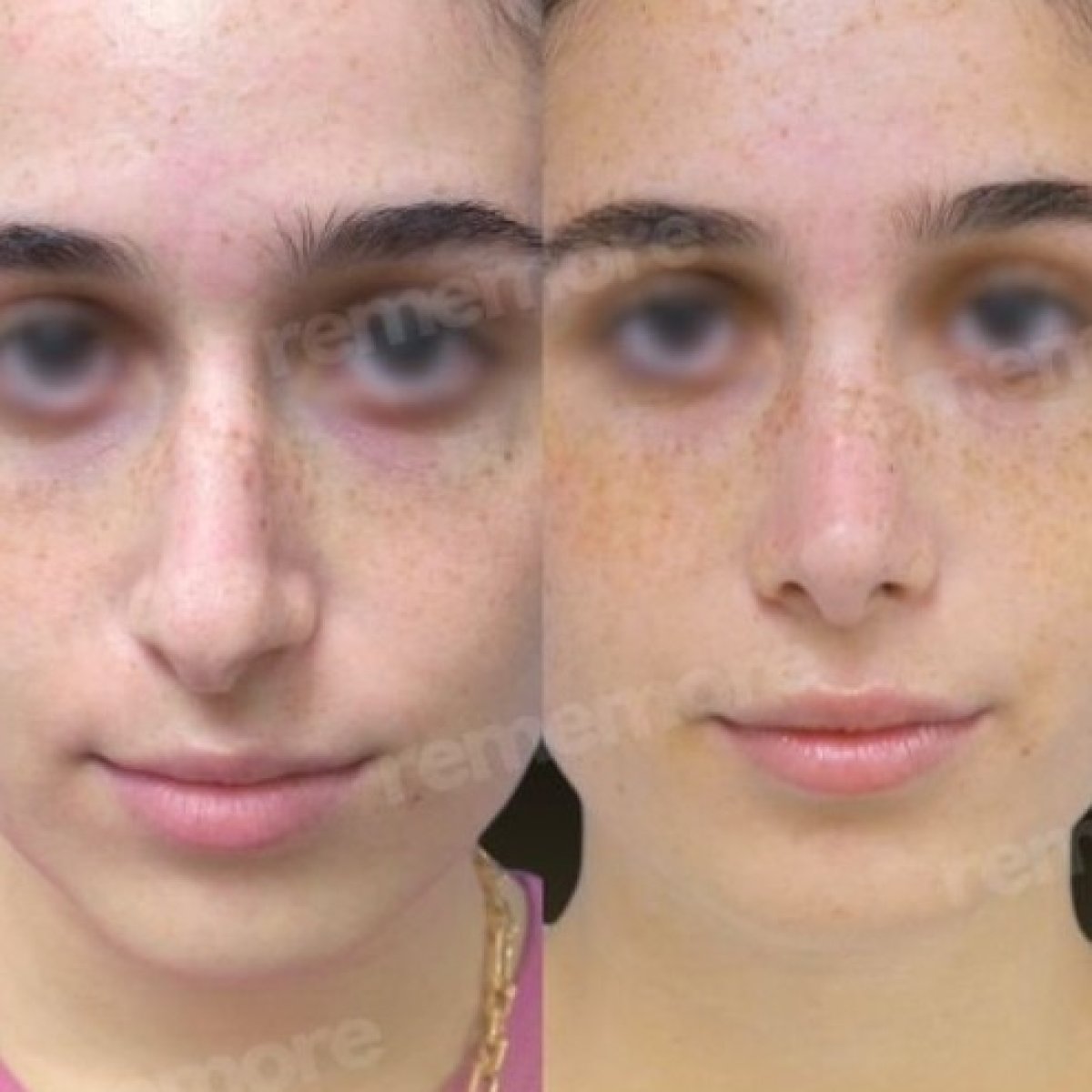 نتائج قبل وبعد عملية تجميل الأنف التصحيحية في مستشفى ميموريال بهجيليفلر، إعادة تشكيل الأنف