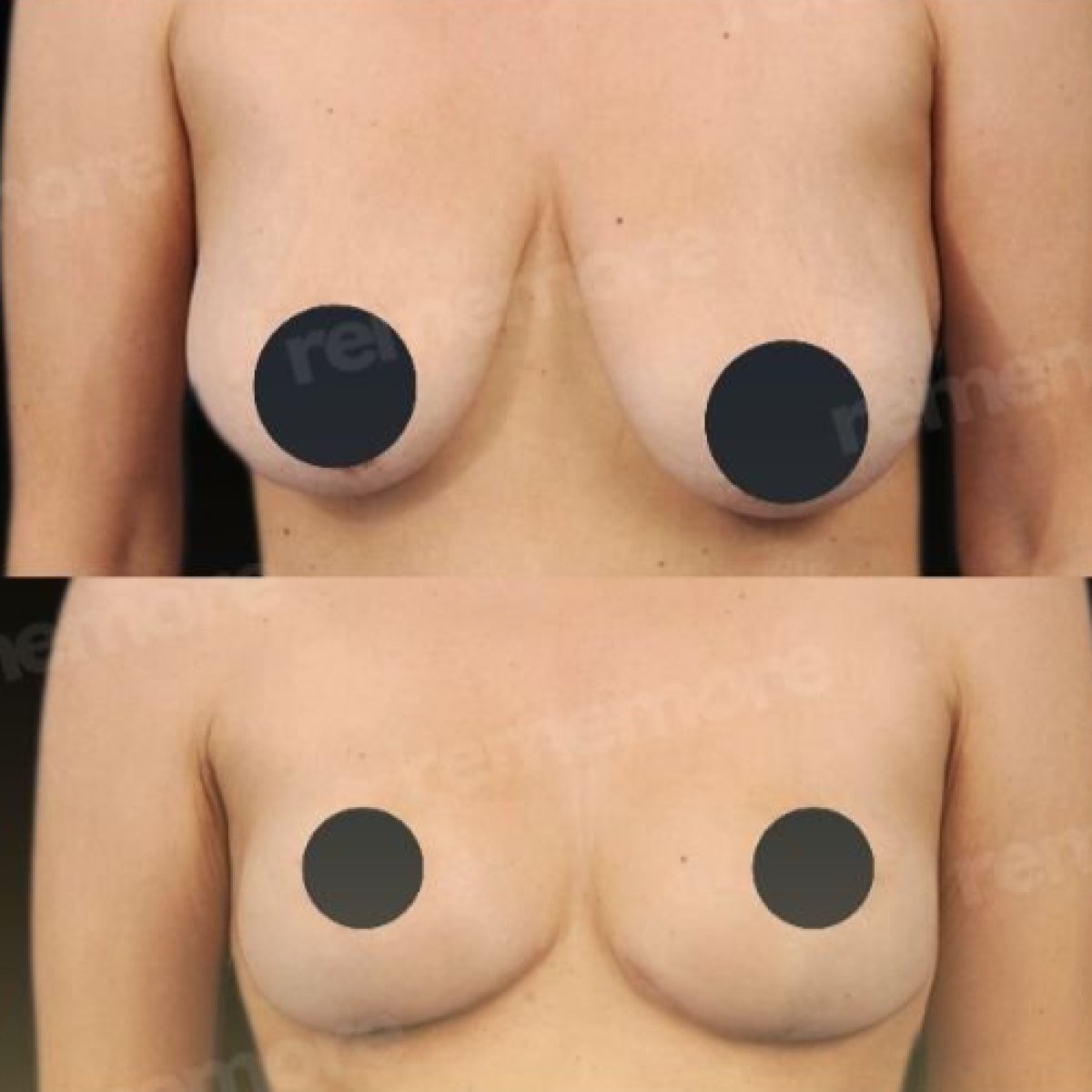 Before and after breast lift with round implants at Memorial Bahçelievler Hospital, visible results