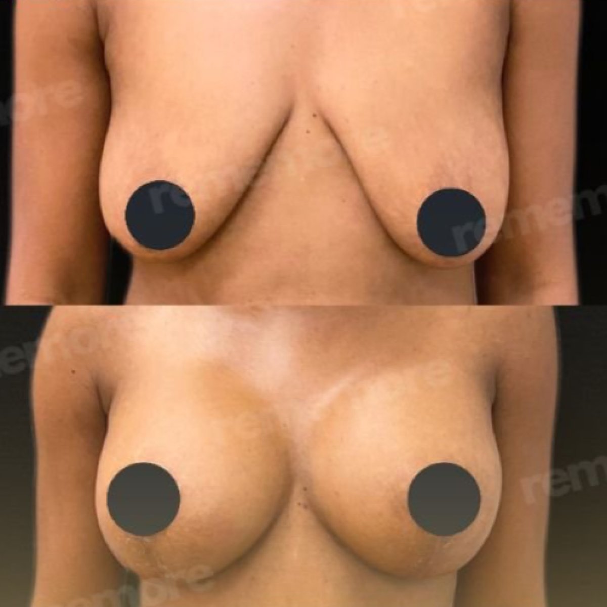 Before and after breast lift with implants round results at Memorial Bahçelievler Hospital