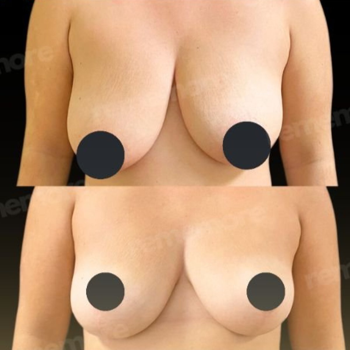 Before and after breast lift with round implants at Memorial Bahçelievler Hospital, visible result