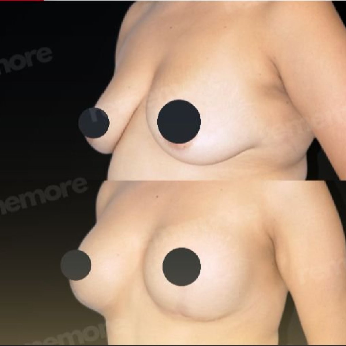 Before and after breast lift with implants results at Memorial Bahçelievler Hospital