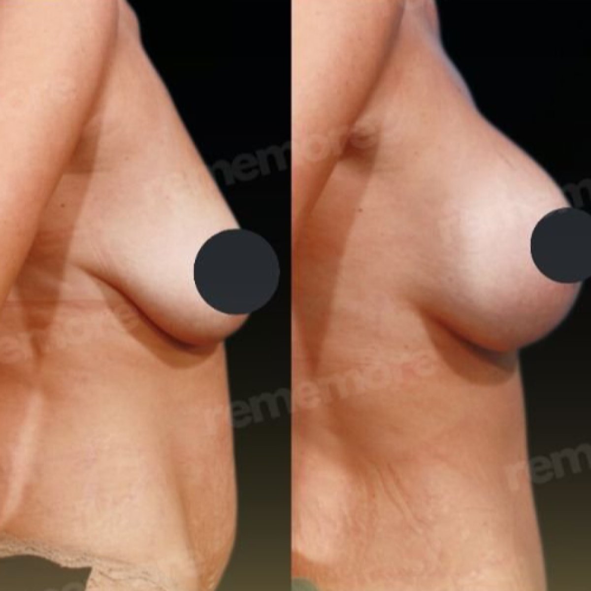 Avant/après lifting mammaire avec implants ronds au Memorial Bahçelievler Hospital, résultat visible