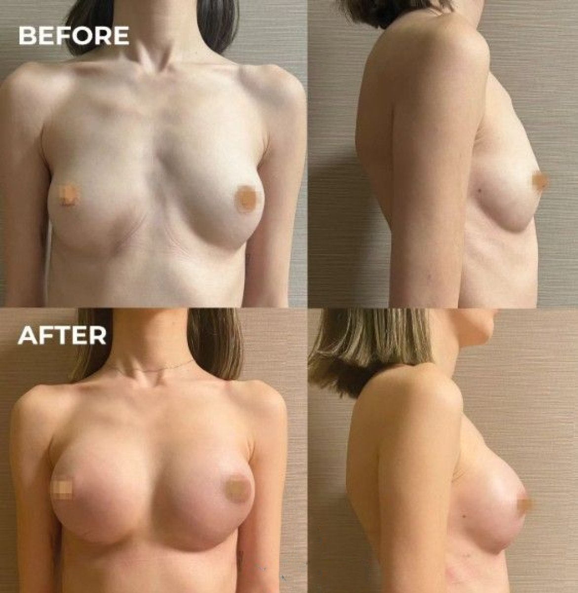 Avant et après lifting mammaire avec implants ronds à Memorial Bahçelievler Hospital, résultat visible