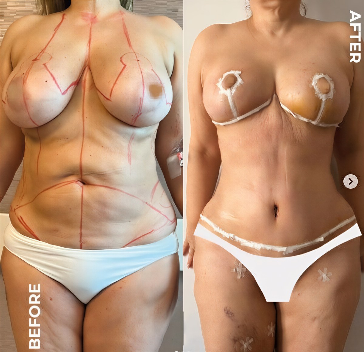 Antes y después de lifting de senos con implantes redondos en Memorial Bahçelievler Hospital, resultados visibles
