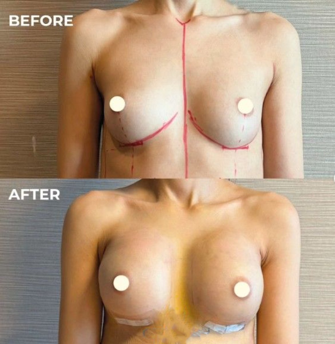 Before and after breast lift with round implants at Memorial Bahçelievler Hospital, visible results