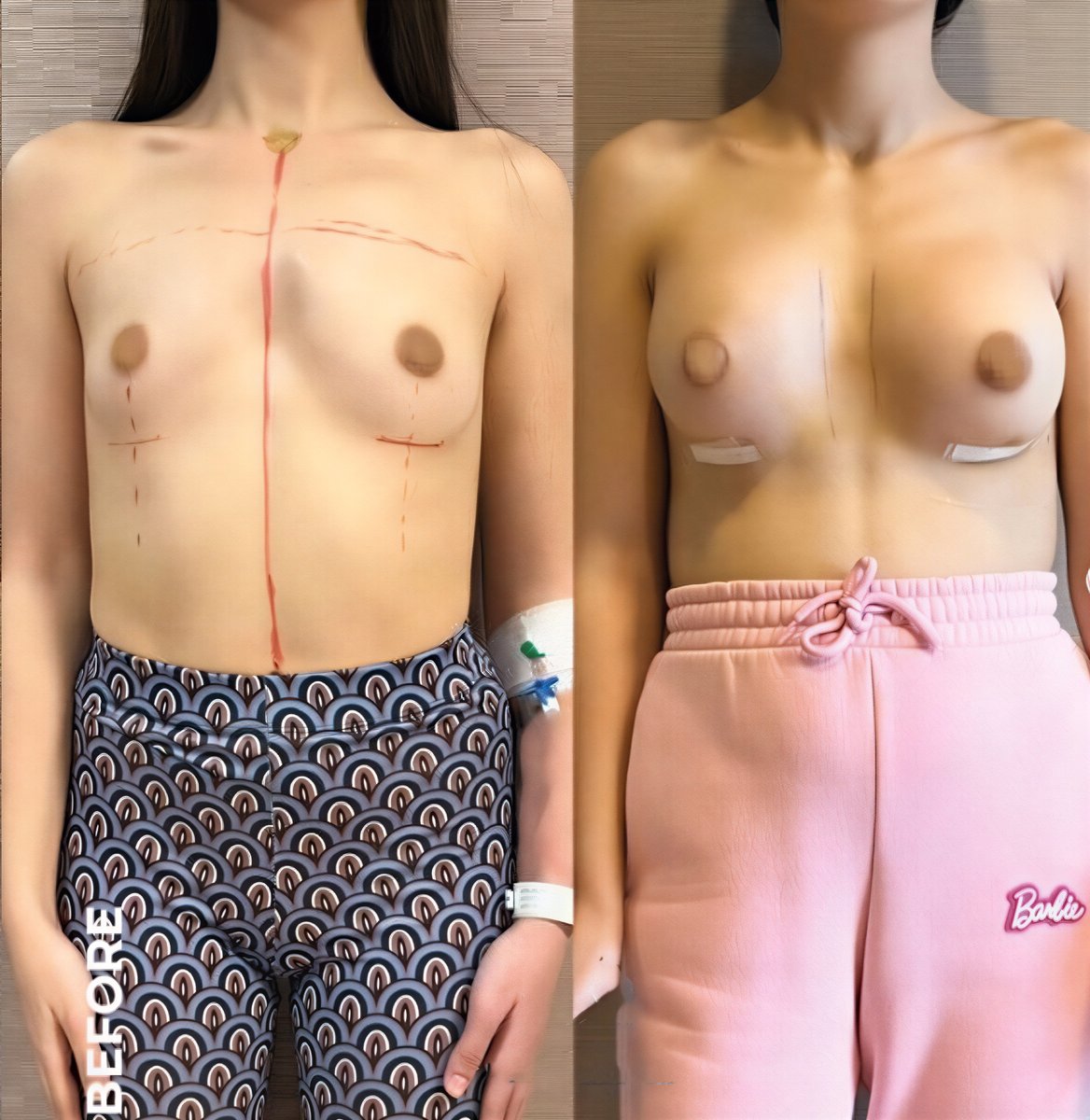 Resultados antes y después de mastopexia con implantes redondos en Memorial Bahçelievler Hospital