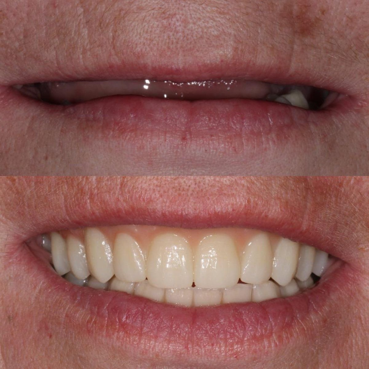 Результати до і після імплантації зубів у Smile Centrum – відновлена посмішка