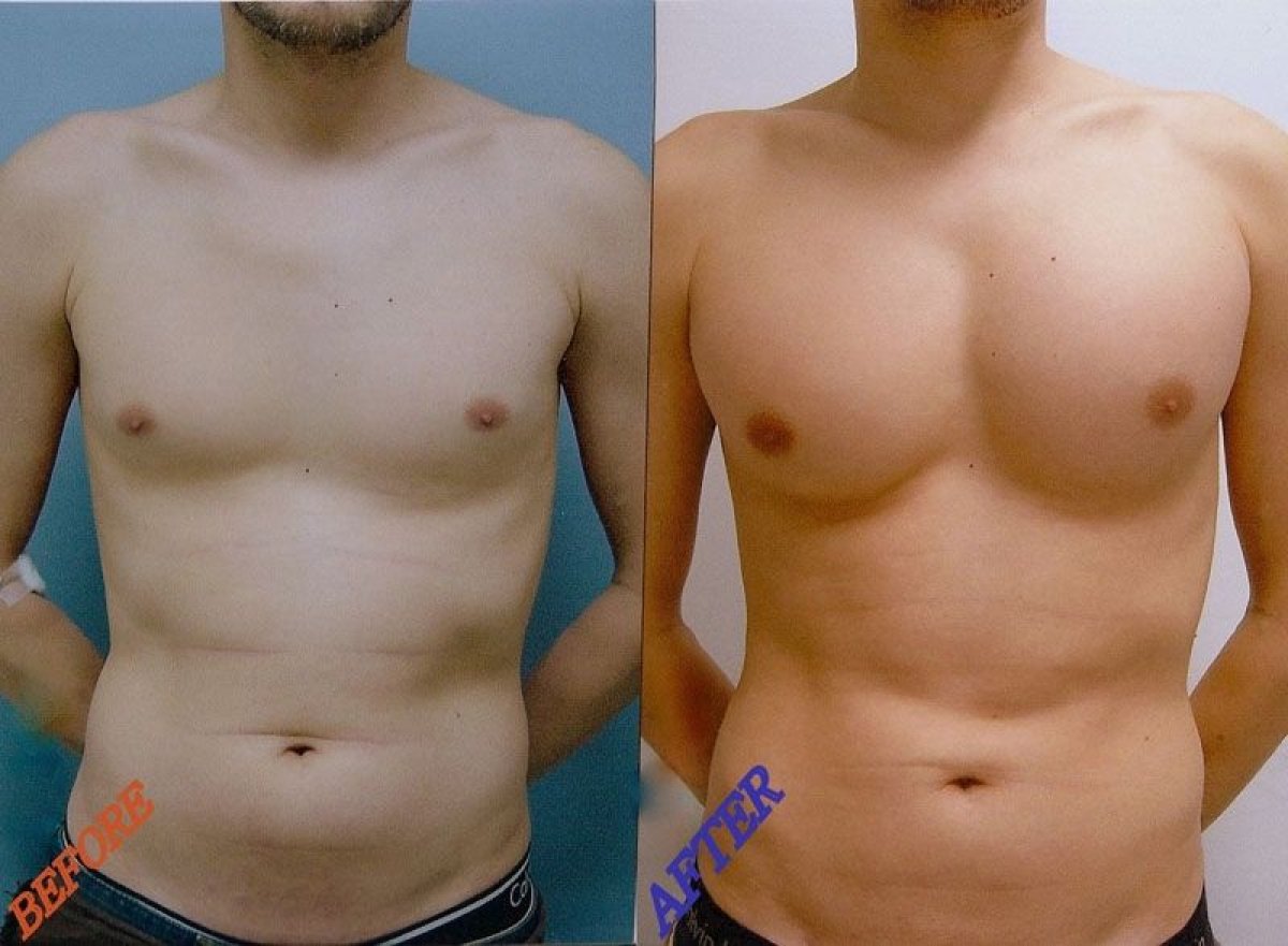Before and after pectoral implants at Wansiri Hospital – enhanced male chest contour result