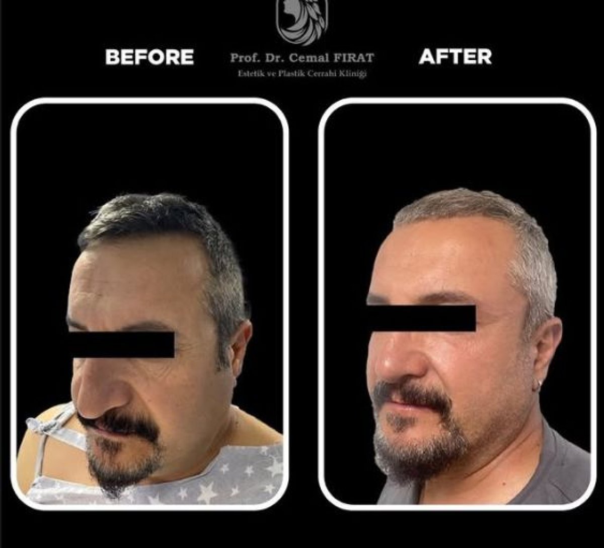 Résultats avant/après lifting du visage à Medical Park Göztepe Hospital Complex, rajeunissement