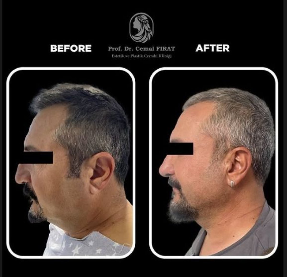 Résultats lifting visage avant/après au Medical Park Göztepe Hospital Complex, cou raffermi