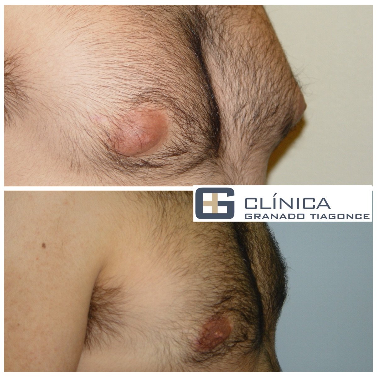 Результаты до и после операции гинекомастии в Clinica Granado Tiagonce, мужская грудь
