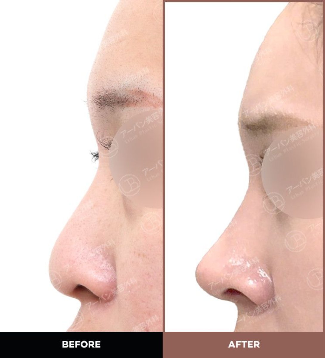 Before and after rhinoplasty results at URBAN Plastic Surgery, improved nose profile