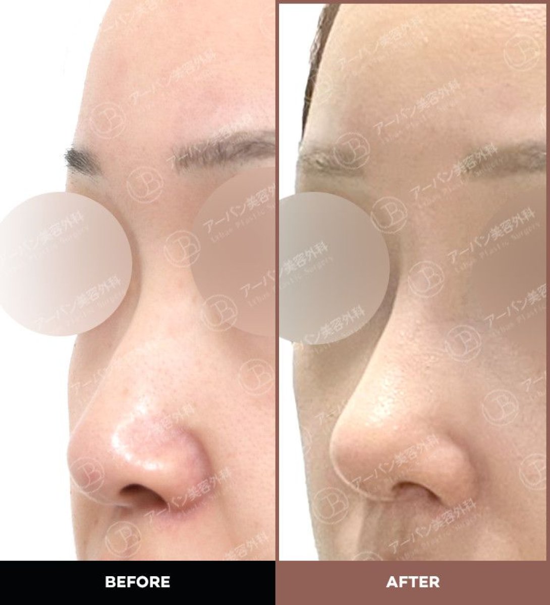Résultats avant et après rhinoplastie chez URBAN Plastic Surgery, forme du nez améliorée