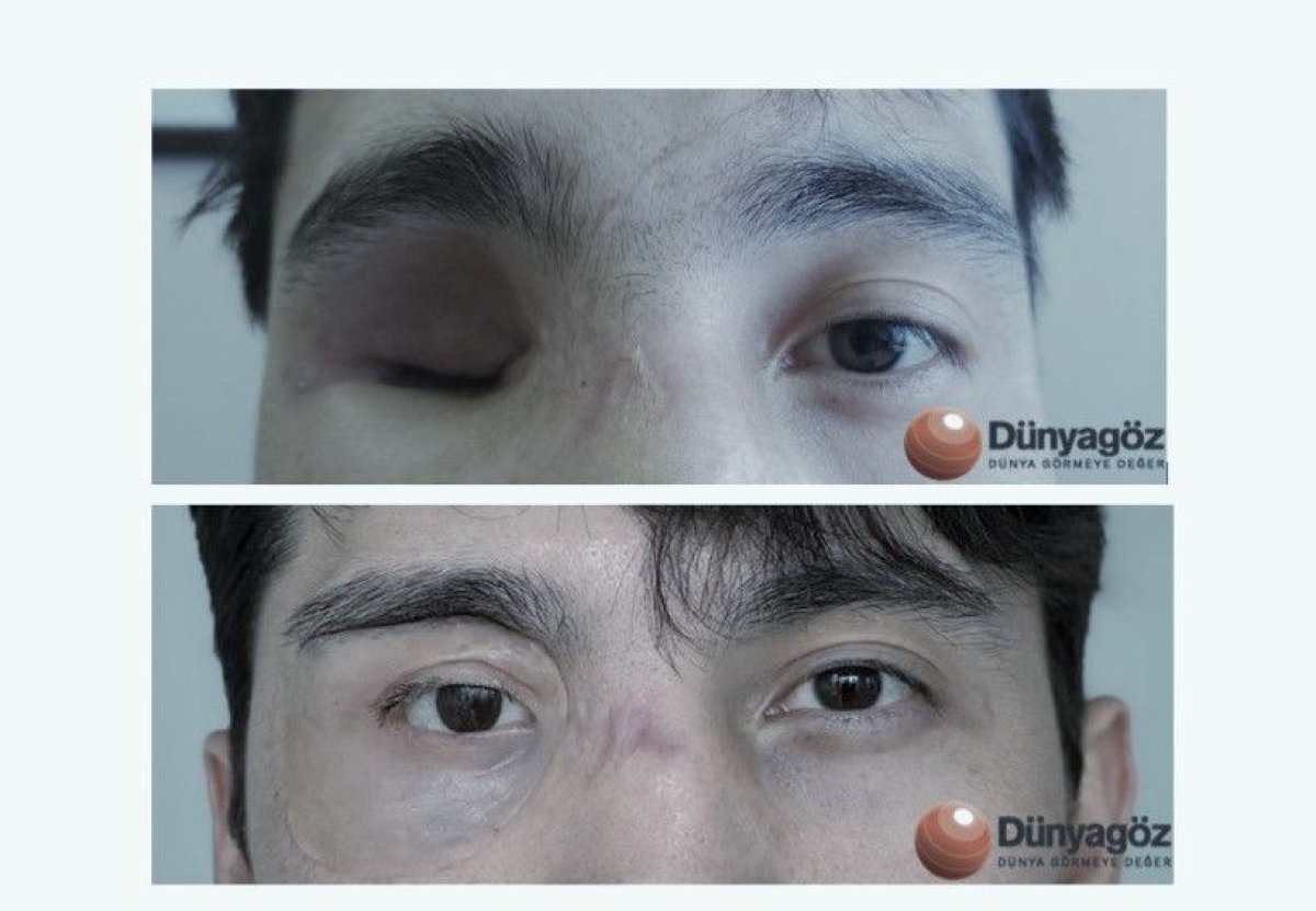 Результаты до и после установки глазного протеза в Dunyagoz Eye Hospital Istanbul Altunizade