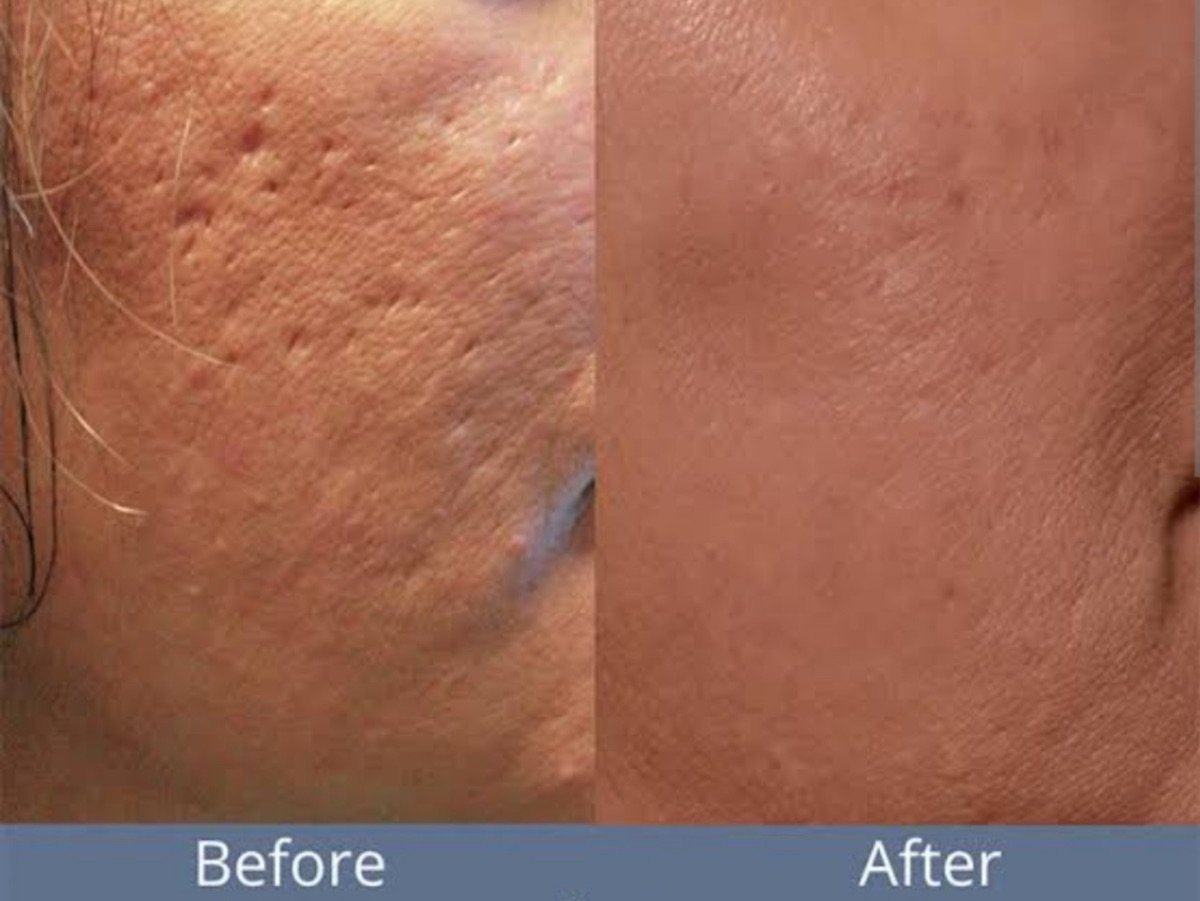 Before and after Morpheus8 skin tightening results at ID Clinic Bangkok, smoother facial skin
