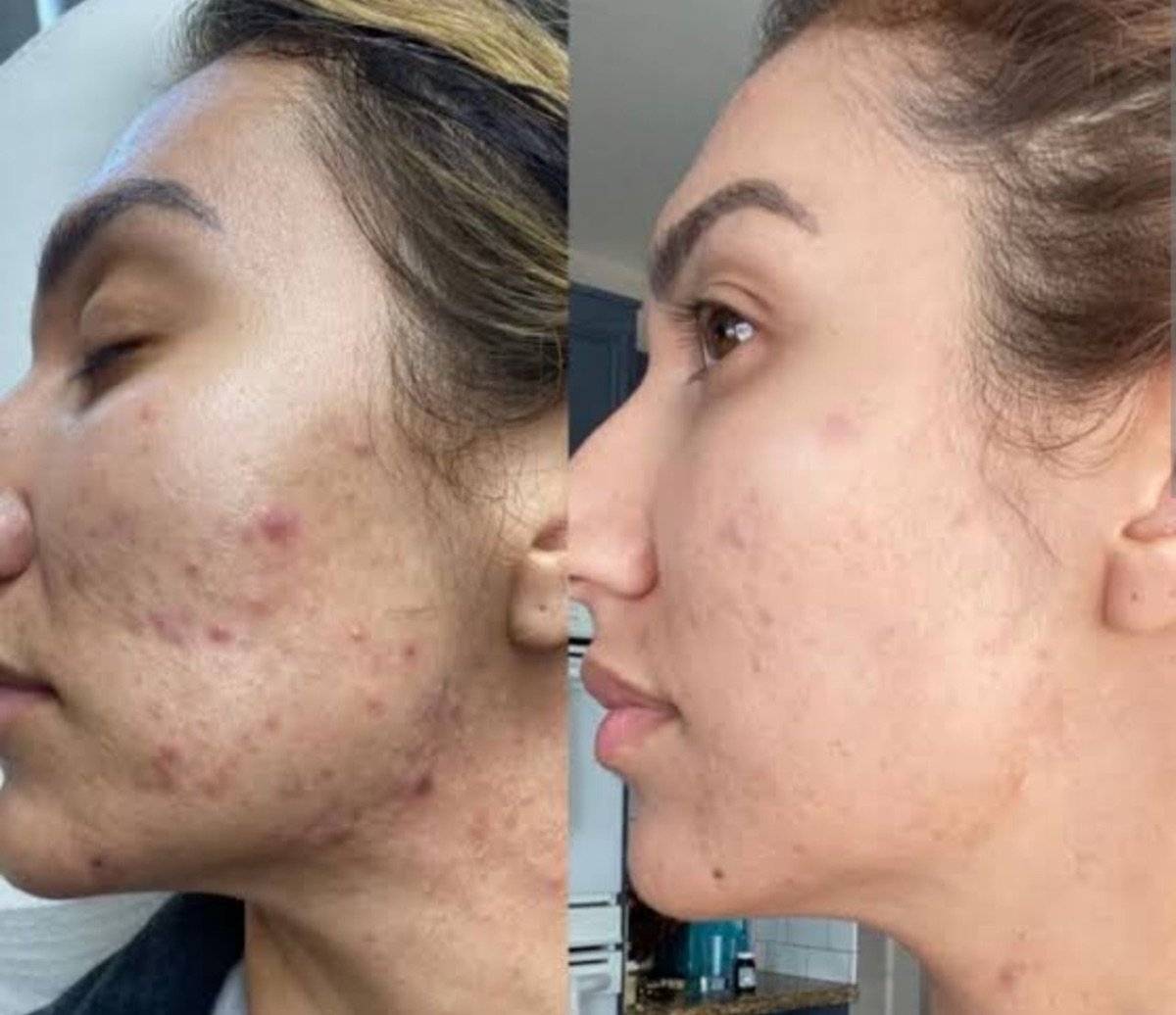 Before and after Morpheus8 skin tightening results at ID Clinic Bangkok for acne scars