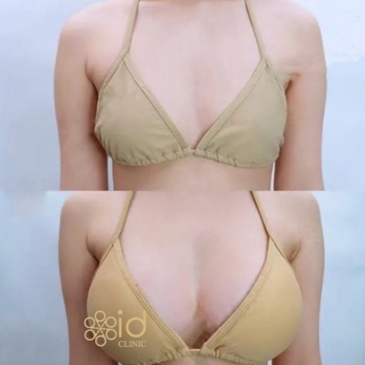 Before and after breast augmentation results at ID Clinic Bangkok, enhanced breast volume