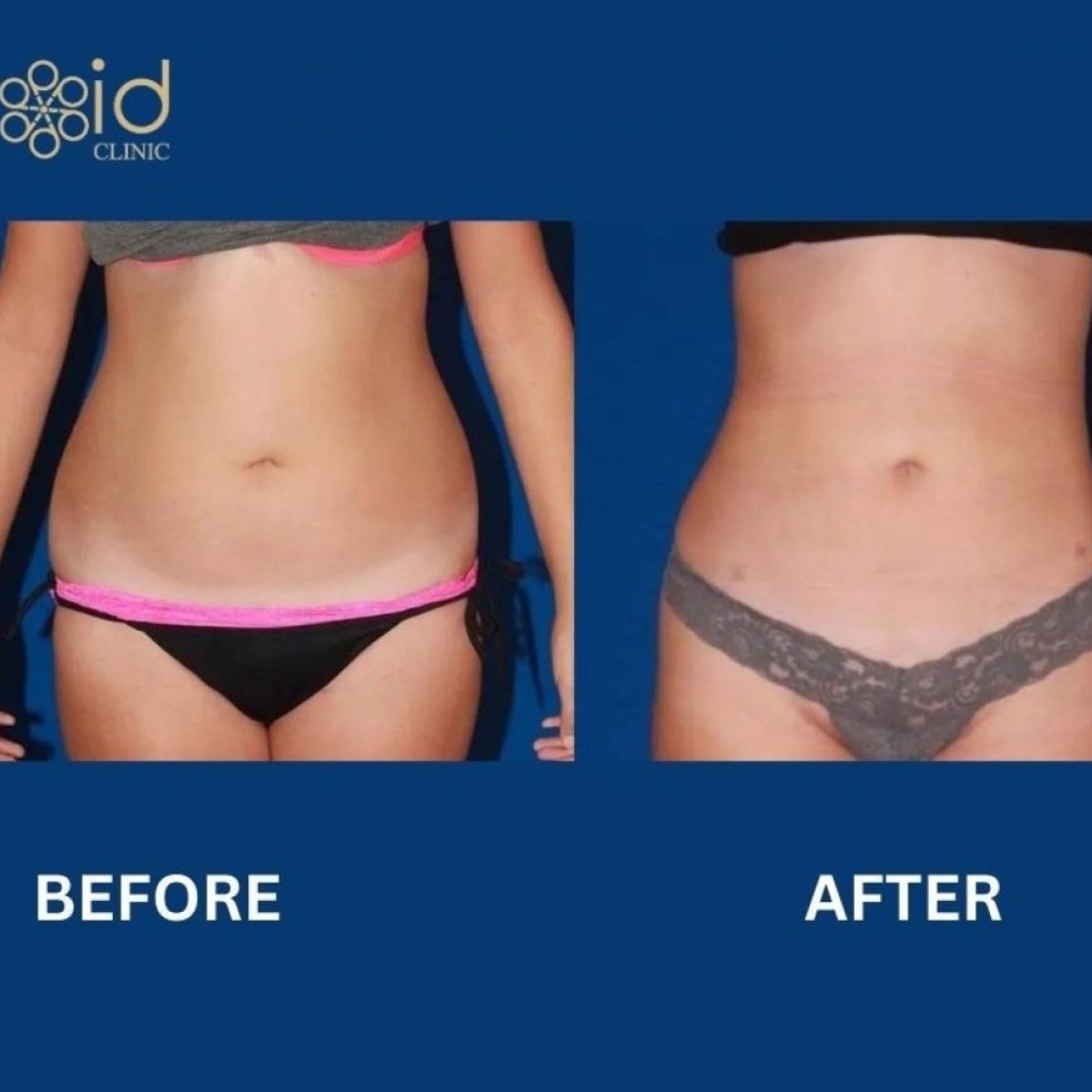 Before and after liposuction results at ID Clinic Bangkok – improved waist contour visible