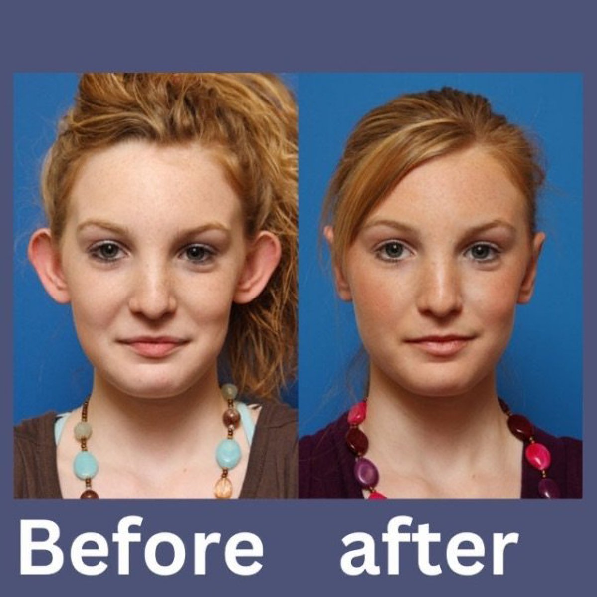 Before and after otoplasty results at ID Clinic Bangkok, ear reshaping for natural look