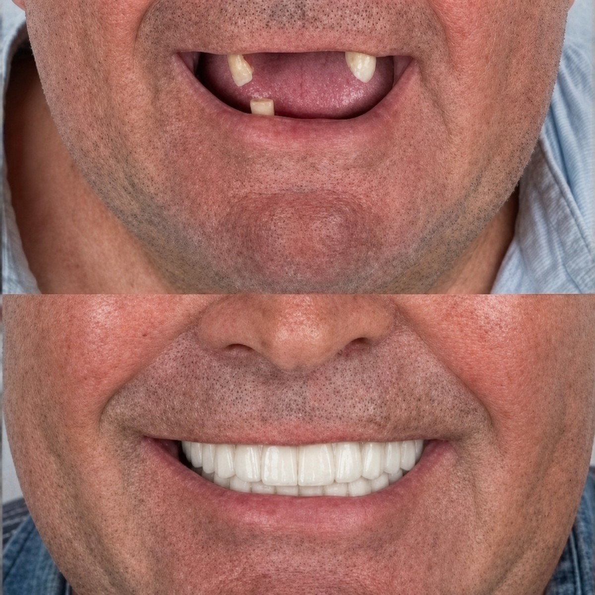 Результат до и после имплантации All-on-6 в Dentfix Turkey Clinic, восстановленная улыбка