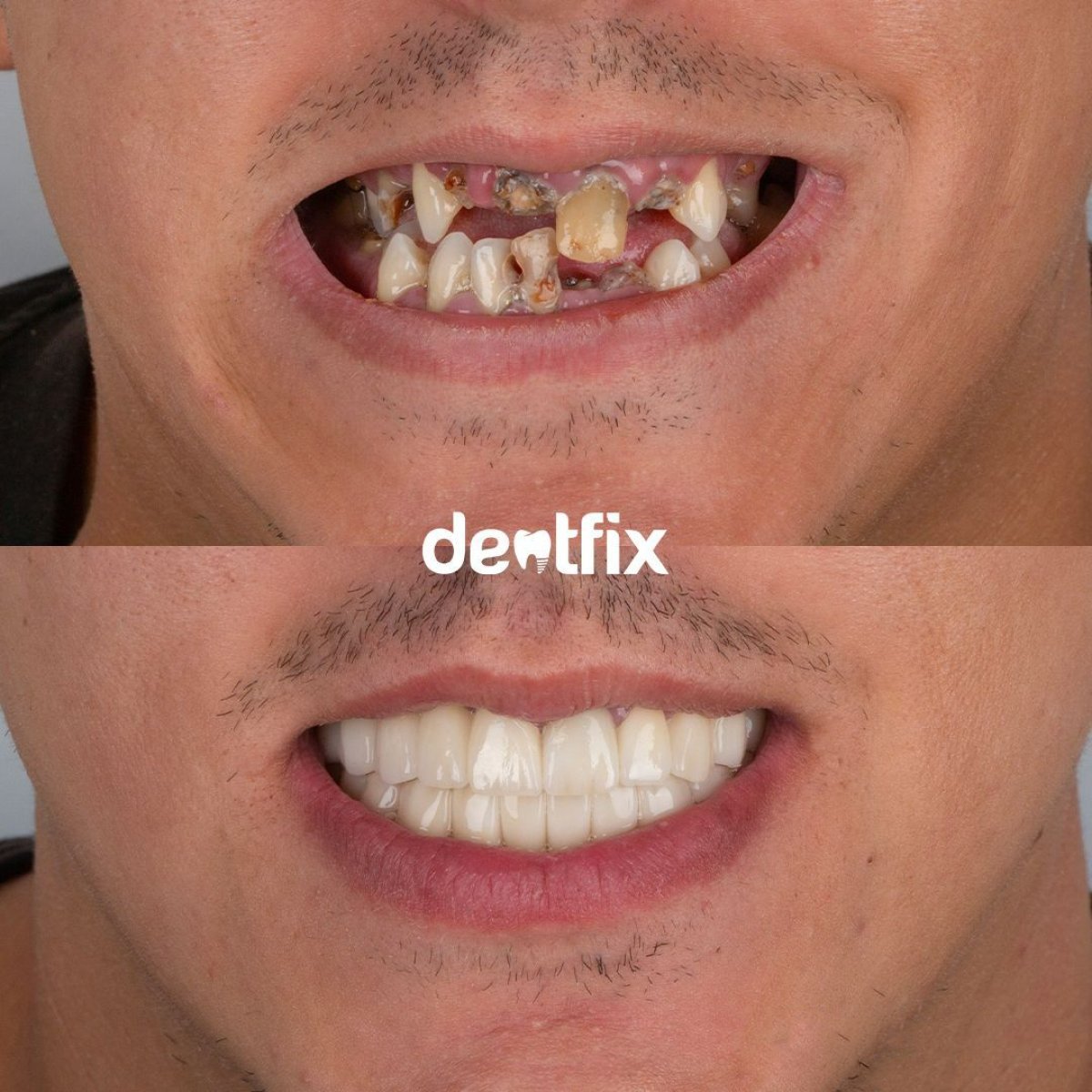 Результаты до и после установки циркониевых коронок в Dentfix Turkey Clinic, восстановление улыбки