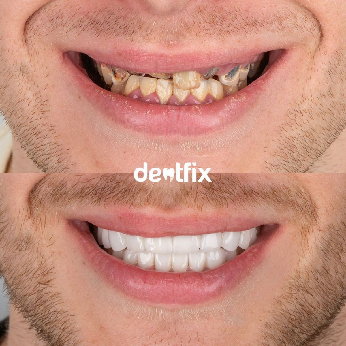 نتائج قبل وبعد تركيب تيجان الزركونيا في Dentfix Turkey Clinic، تحول الابتسامة