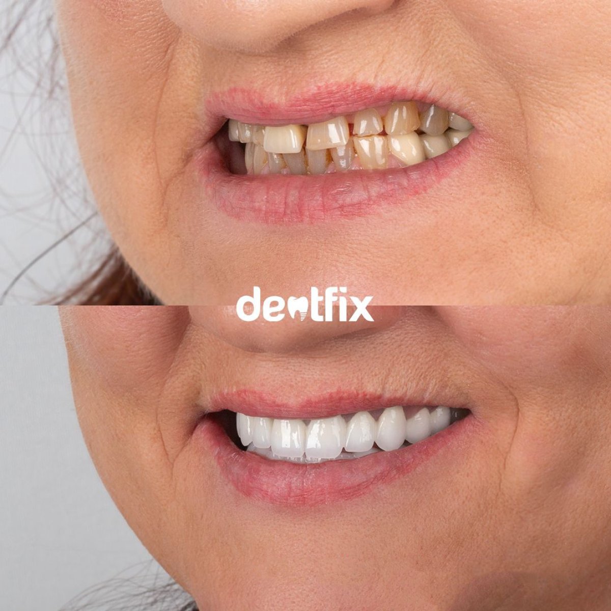 Результаты до и после установки зубных коронок в Dentfix Turkey Clinic, улучшенная улыбка