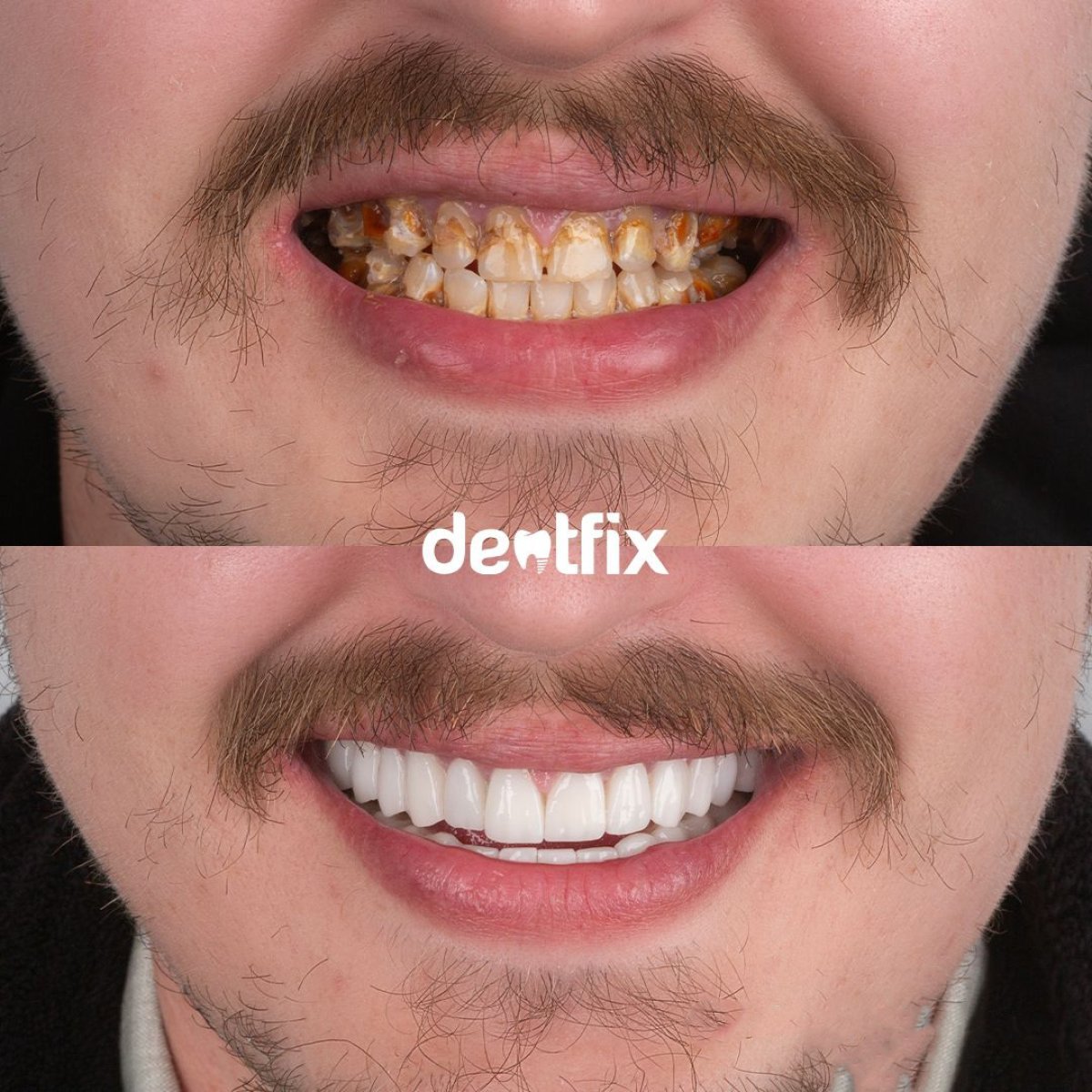 نتائج قبل وبعد تركيب تيجان الأسنان في Dentfix Turkey Clinic، تحول الابتسامة
