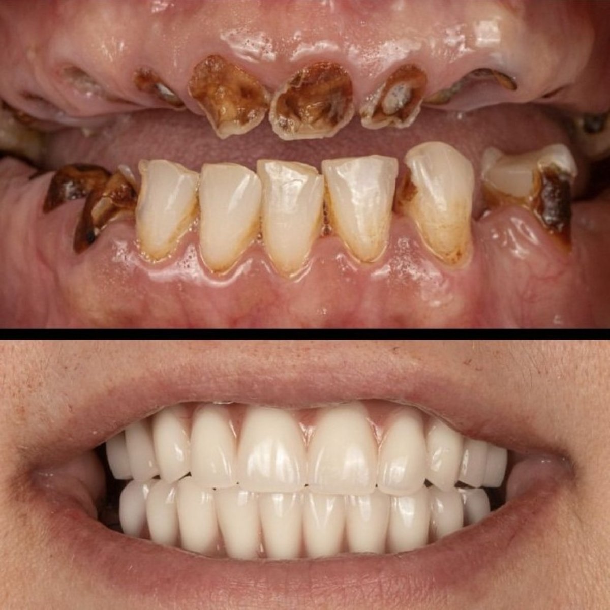 Resultados antes y después de implantes dentales en HALDENT Dental Clinic – sonrisa restaurada