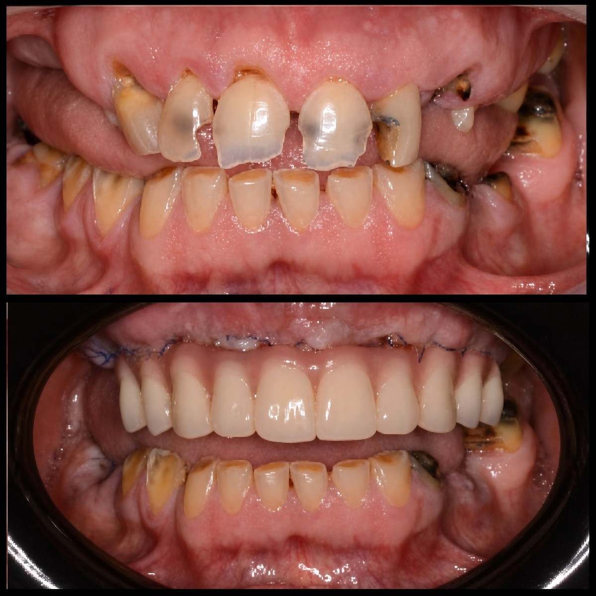 Before and after dental implant results at HALDENT Dental Clinic, restored smile transformation