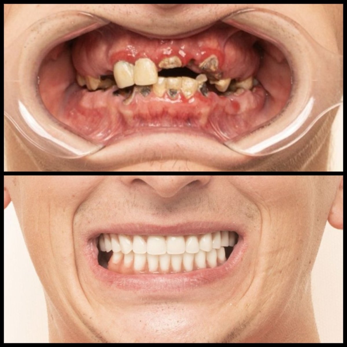 Resultados antes y después de implantes dentales en HALDENT Dental Clinic – sonrisa restaurada