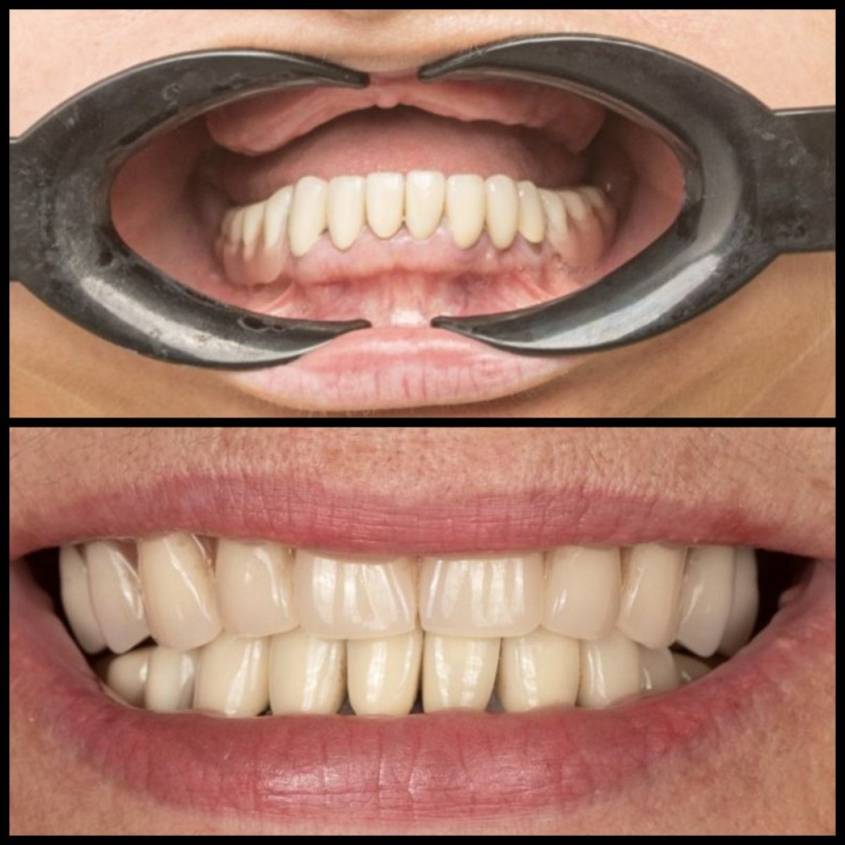 Resultados antes y después de implantes dentales en HALDENT Dental Clinic, sonrisa mejorada