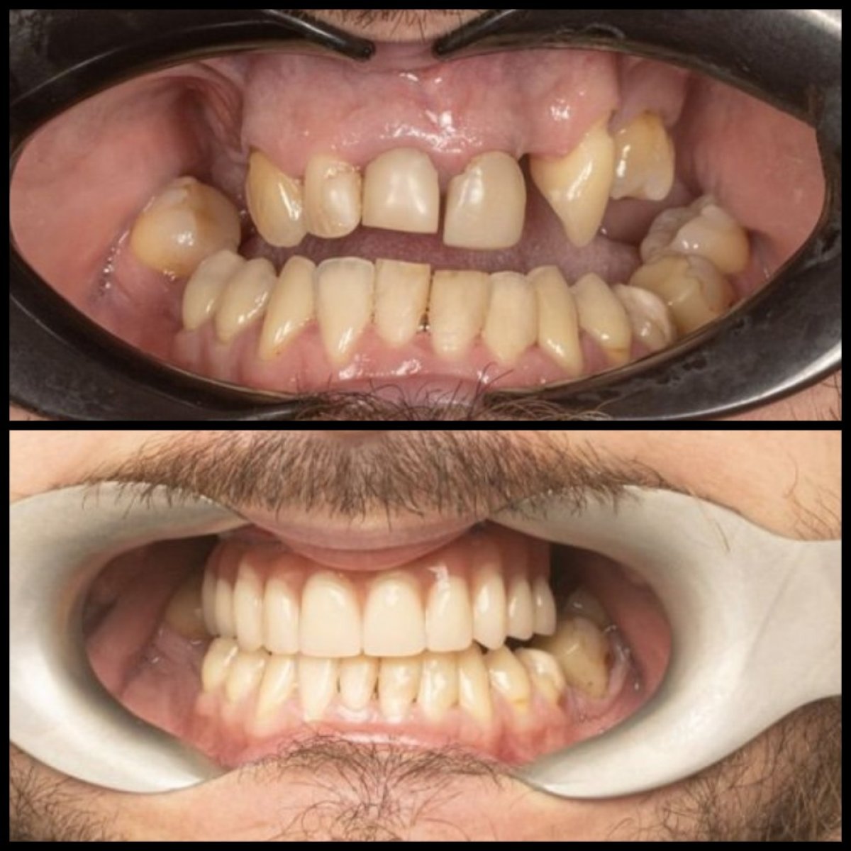 Before and after dental implant results at HALDENT Dental Clinic, improved smile restoration