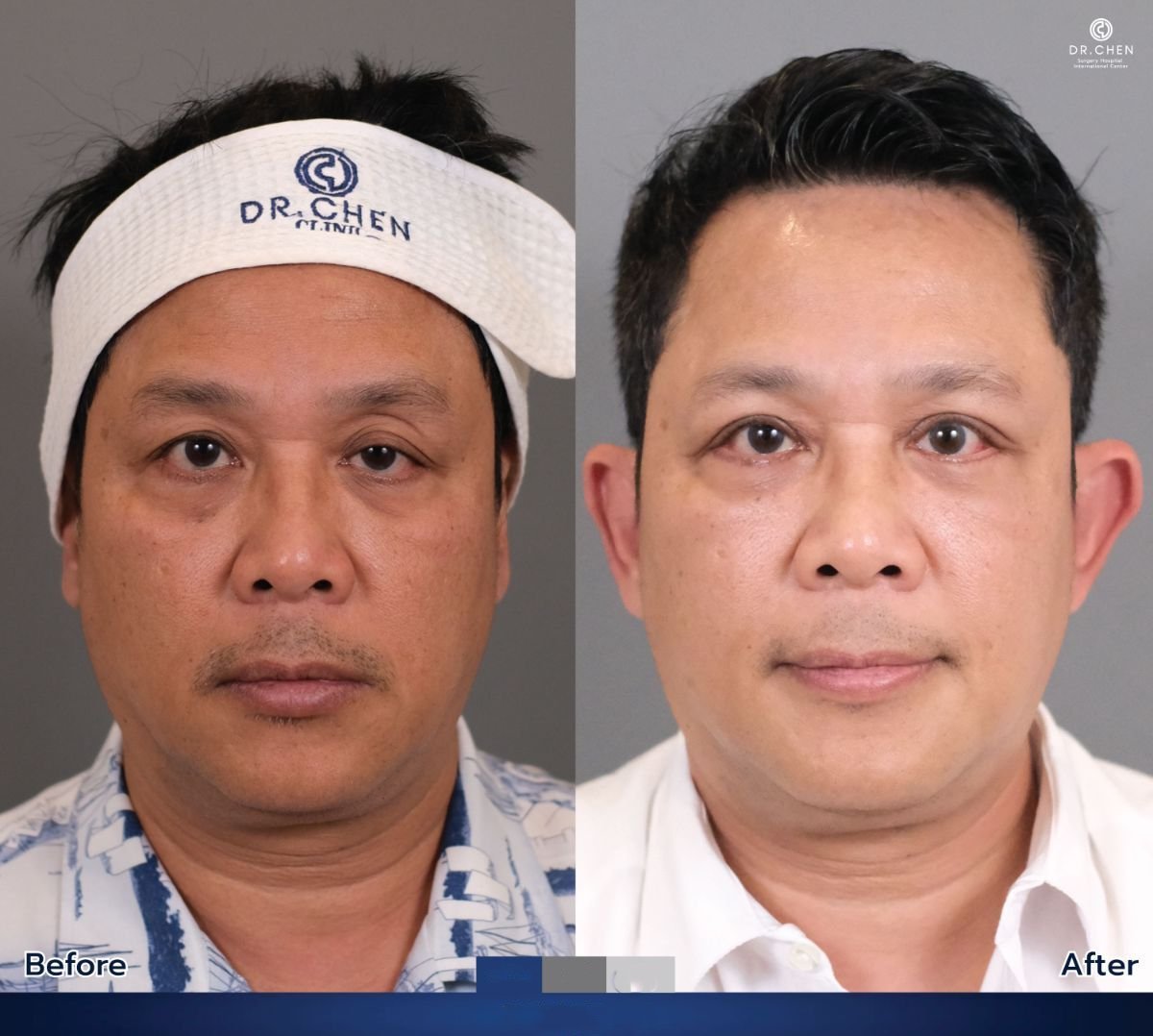 نتيجة حقن البوتوكس قبل وبعد في Dr. Chen Surgery Hospital International Center، جبهة أكثر نعومة