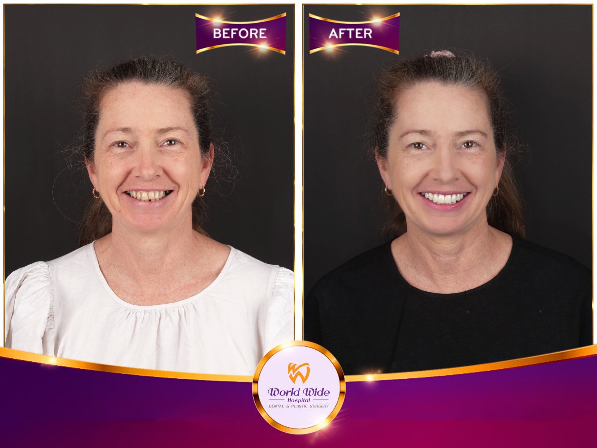 Porcelain crown installation before and after result at World Wide Hospital, improved smile