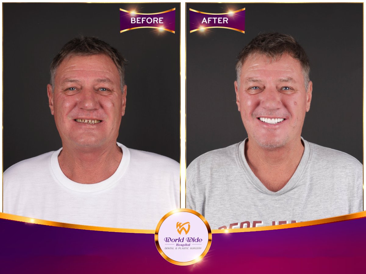 Porcelain crown installation before and after result at World Wide Hospital – smile makeover