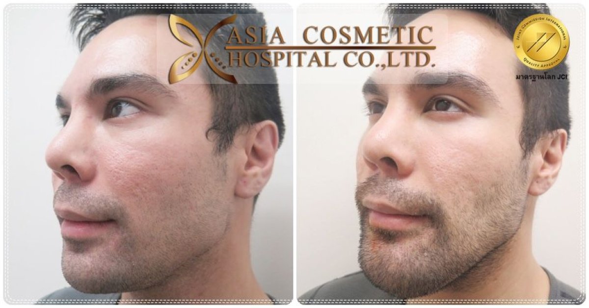 Facelift before and after results at Asia Cosmetic Hospital, visible facial rejuvenation