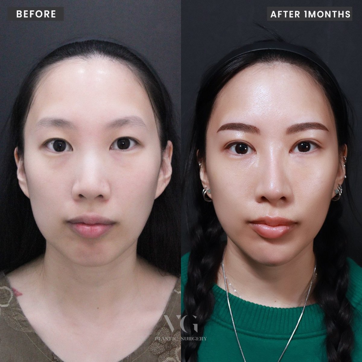 Before and after double eyelid surgery results at VG Plastic Surgery, natural eye enhancement