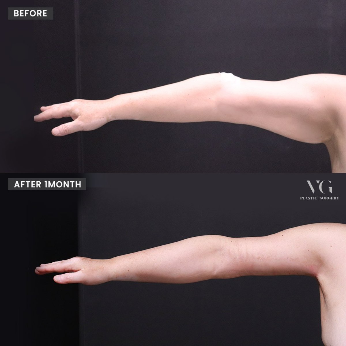 Результати ліпосакції верхньої частини руки до і після у VG Plastic Surgery, стрункіша рука