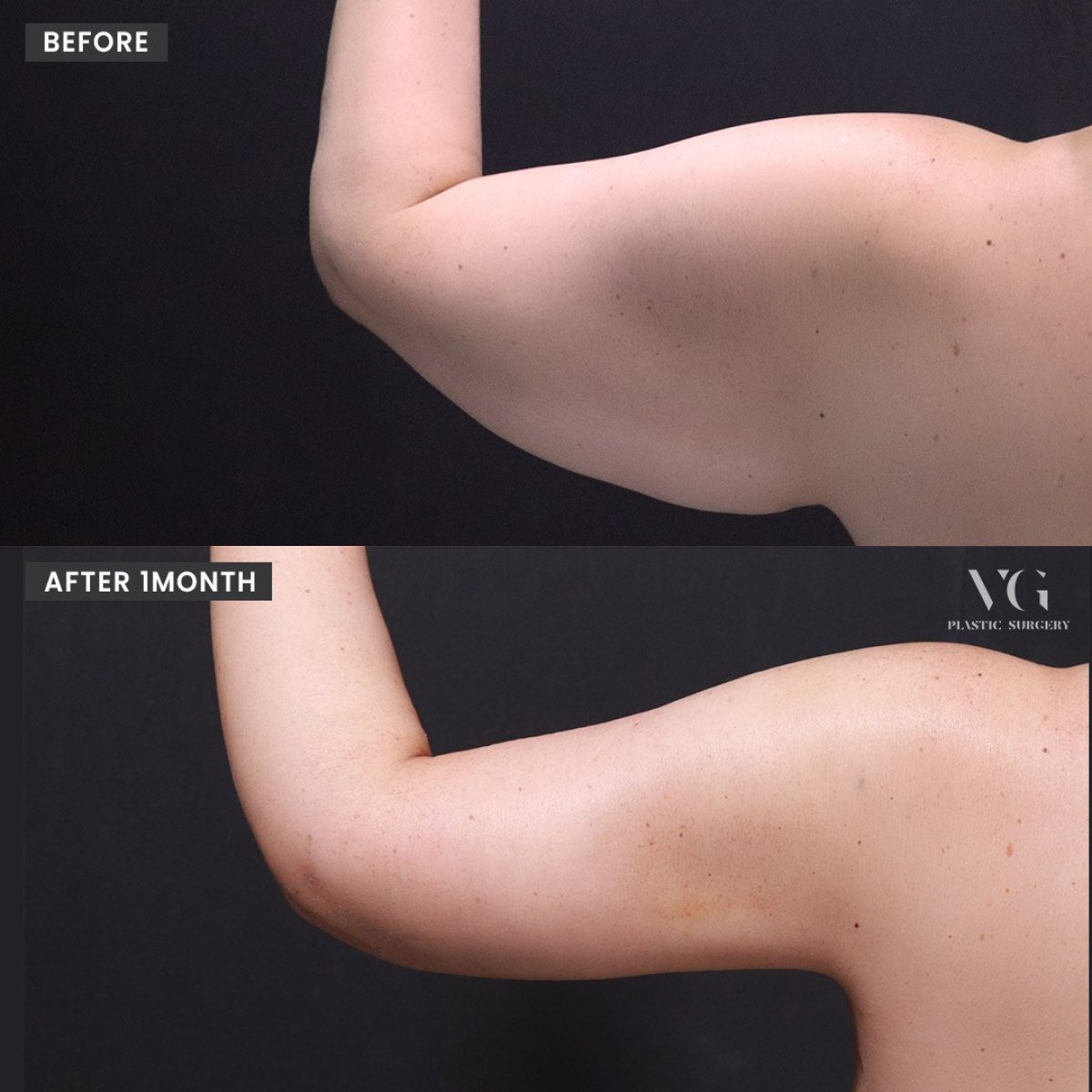 Before and after upper arm liposuction results at VG Plastic Surgery, slimmer arm contour