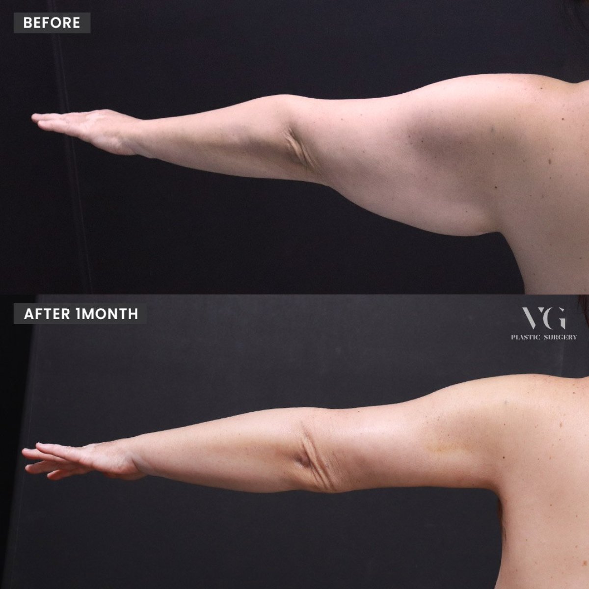 Before and after upper arm liposuction results at VG Plastic Surgery, slimmer arm contour