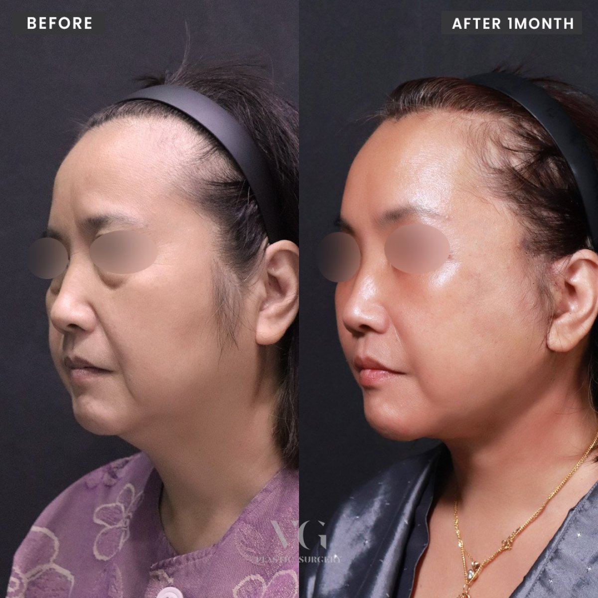 نتائج شد الوجه قبل وبعد في VG Plastic Surgery، تحسين واضح لتحديد ملامح الوجه